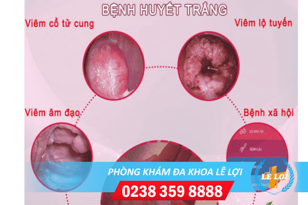 huyết trắng bệnh gì