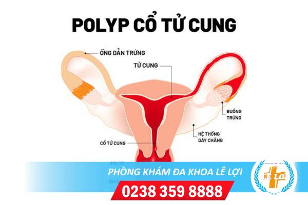 Polyp-co-tu-cung