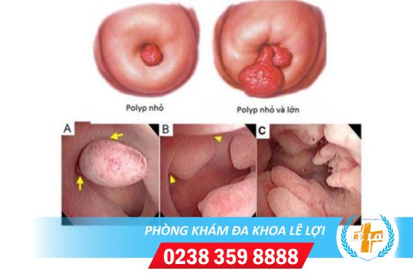 Cat-polyp-co-tu-cung-co-hieu-qua-va-an-toan-khong-1