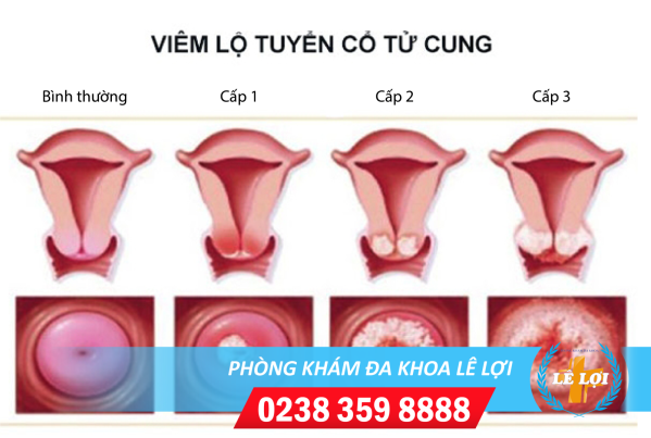 Viem-lo-tuyen-co-tu-cung